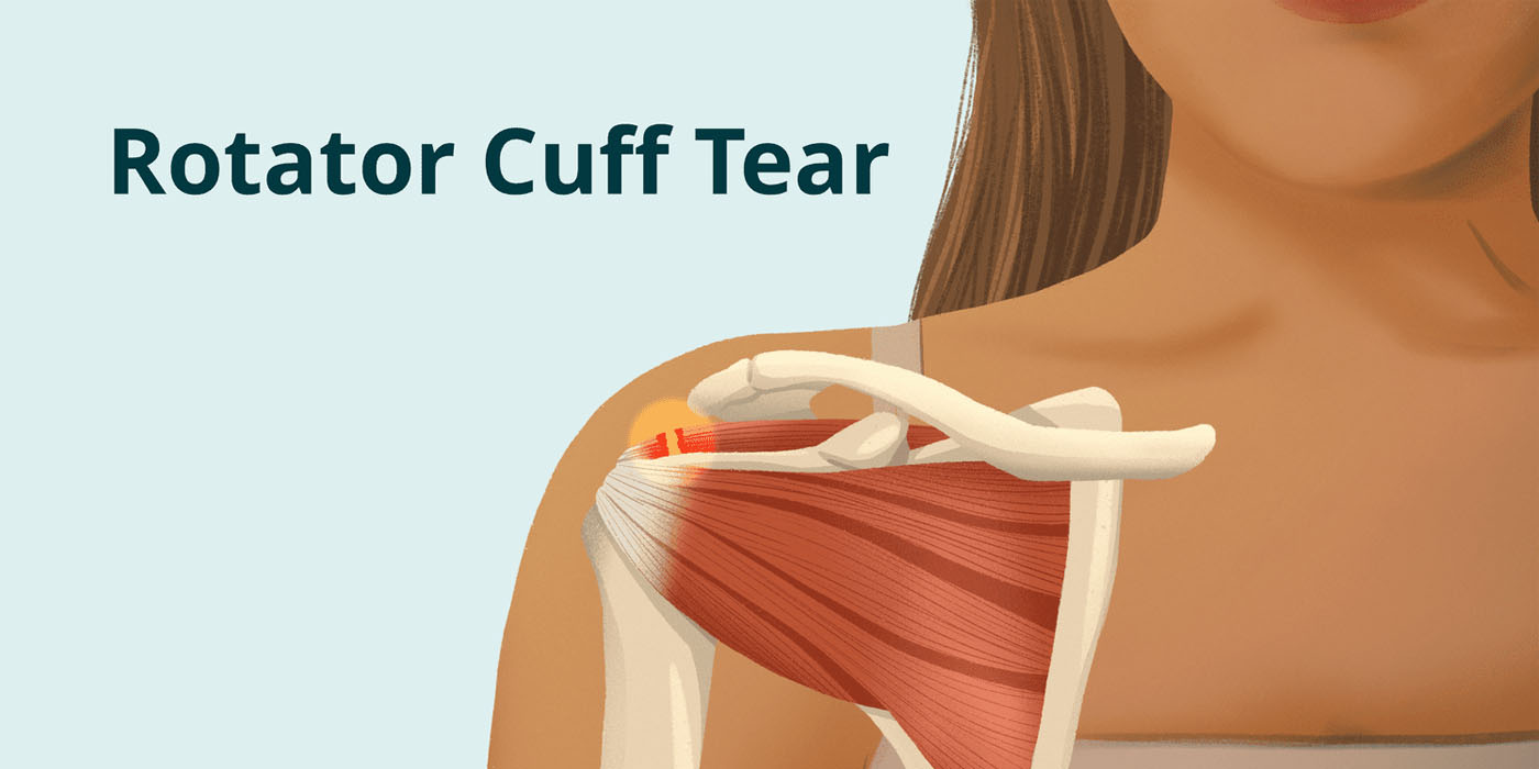 rotator-cuff-tears