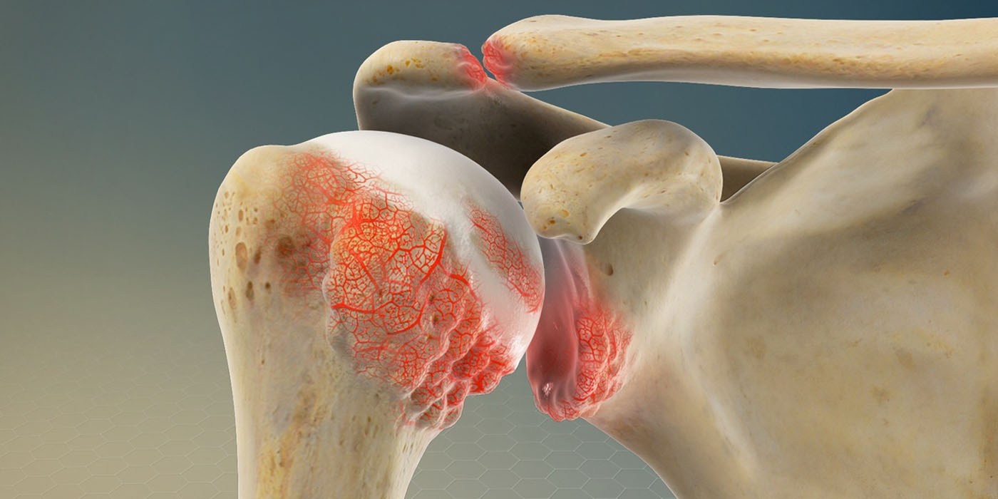 shoulder-arthritis
