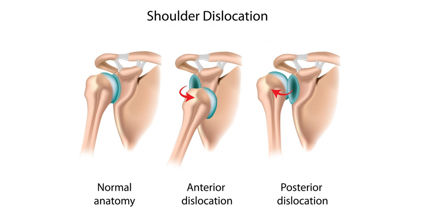 shoulder-dislocation