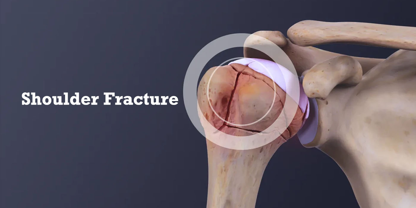 shoulder-fracture