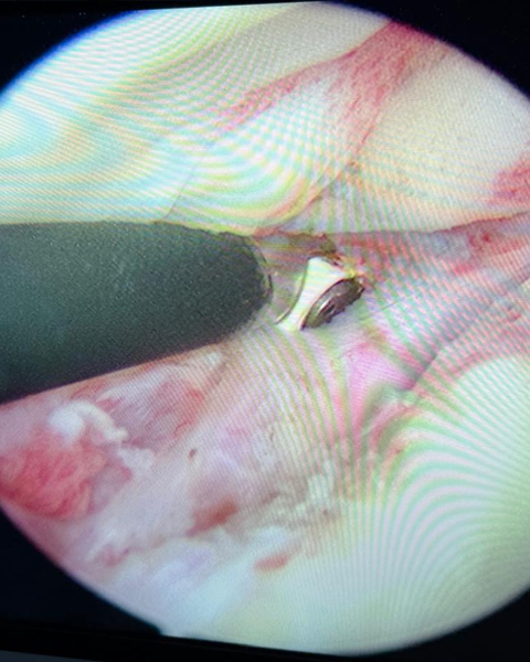 Shoulder Dislocation