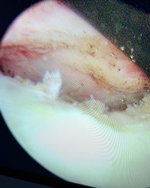 Shoulder Dislocation