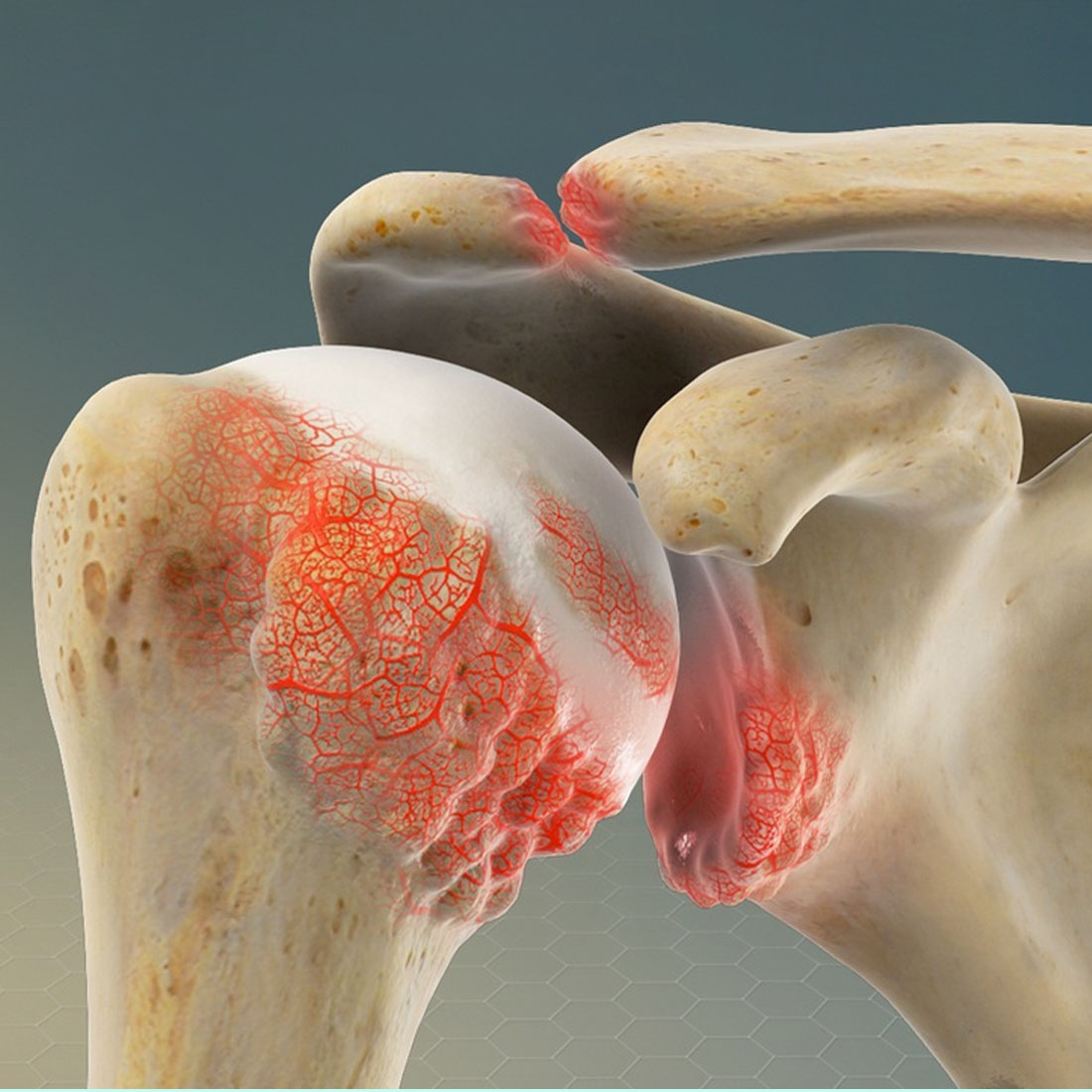 shoulder-arthritis