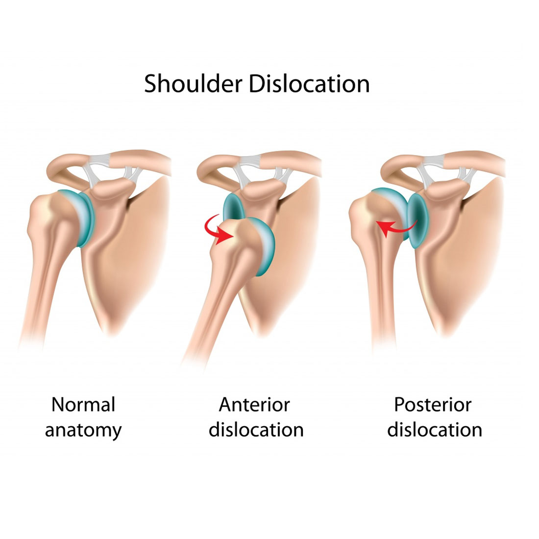 shoulder-dislocation