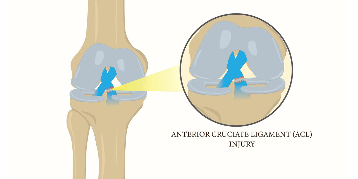 acl-pcl-injury
