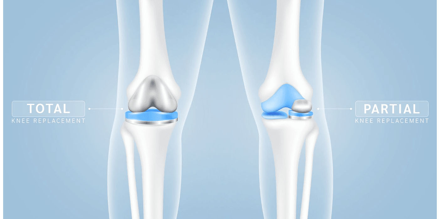 partial-knee-replacement
