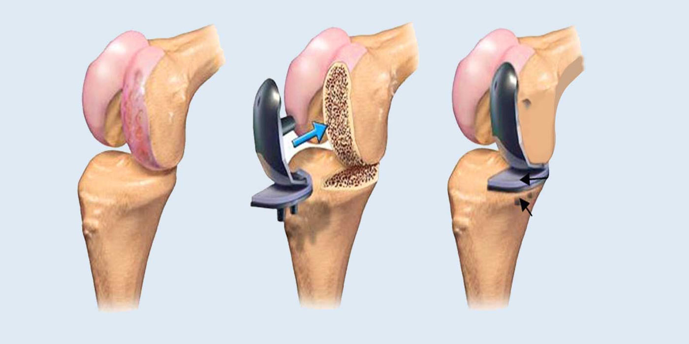 total-knee-replacement